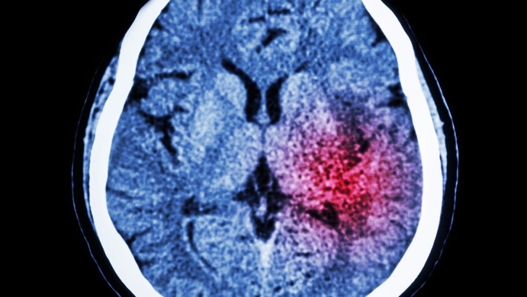 Humanin ischemic brain injury | Shaanxi BLOOM Tech Co., Ltd Humanin ischemic brain injury | Shaanxi BLOOM Tech Co., Ltd