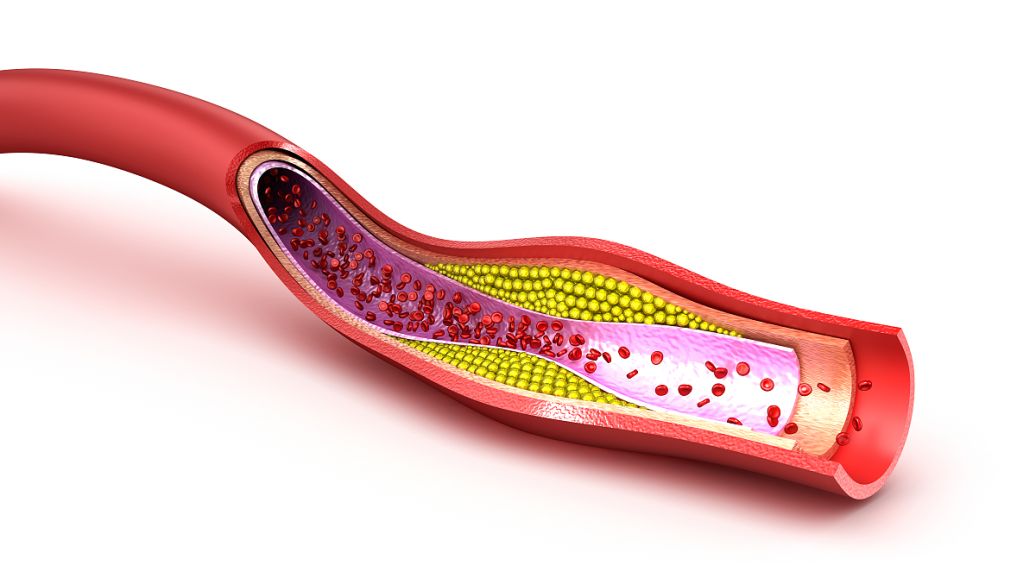 血管硬化如何治疗？
