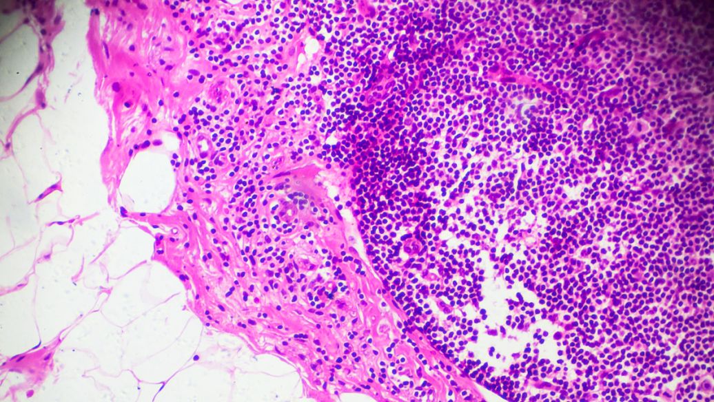 Angiotensin II acetate patients | Shaanxi BLOOM Tech Co., Ltd