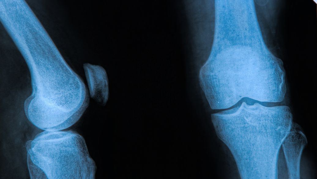 β-estradiol uses | Shaanxi BLOOM Tech Co., Ltd β-estradiol uses | Shaanxi BLOOM Tech Co., Ltd