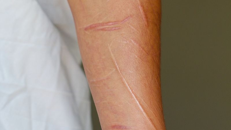 TB 500 wound healing | Shaanxi BLOOM Tech Co., Ltd TB 500 wound healing | Shaanxi BLOOM Tech Co., Ltd