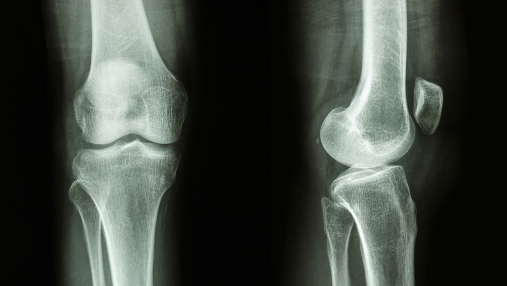 calcitonin salmon uses | Shaanxi BLOOM Tech Co., Ltd calcitonin salmon uses | Shaanxi BLOOM Tech Co., Ltd