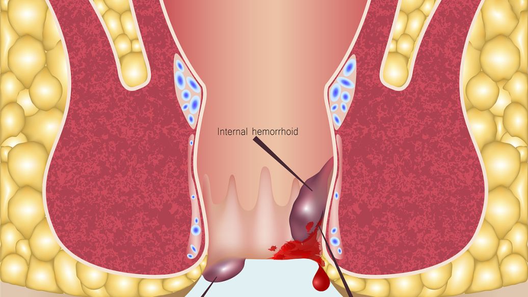 肛乳头肥大怎么办