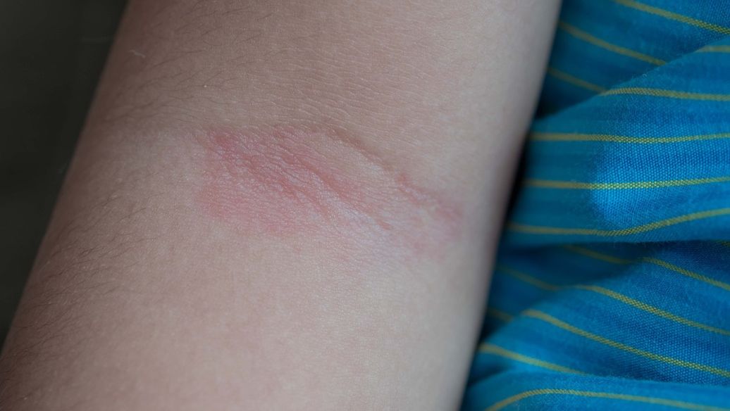 Etelcalcetide uses | Shaanxi BLOOM Tech Co., Ltd Etelcalcetide uses | Shaanxi BLOOM Tech Co., Ltd