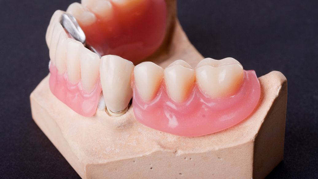 隐形义齿吧-百度贴吧