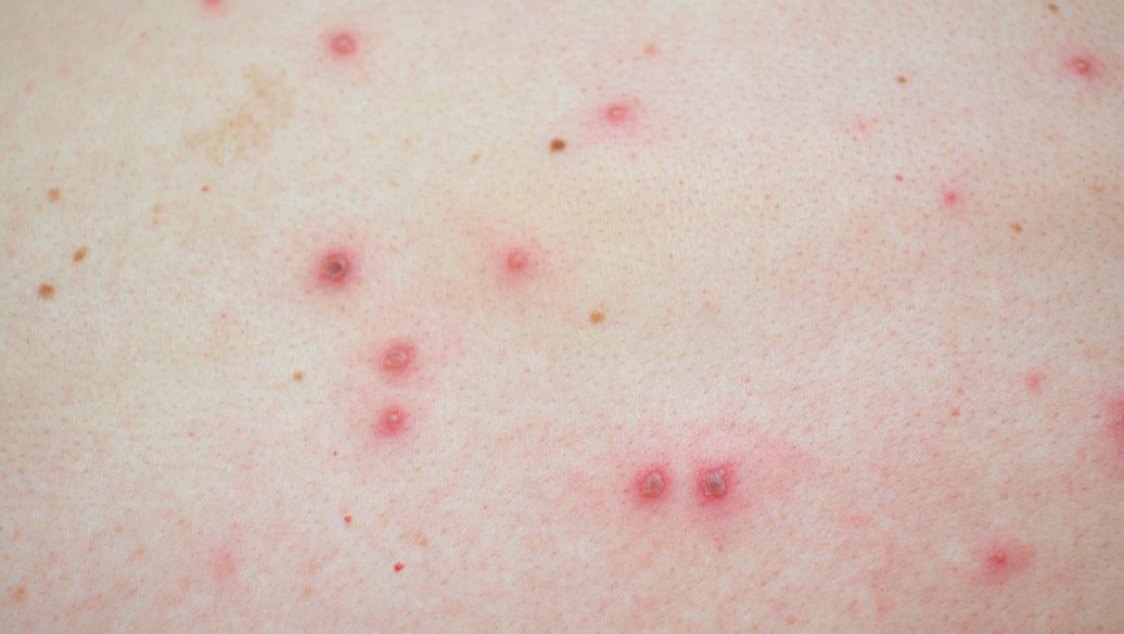 Desmopressin adverse reactions | Shaanxi BLOOM Tech Co., Ltd Desmopressin adverse reactions | Shaanxi BLOOM Tech Co., Ltd