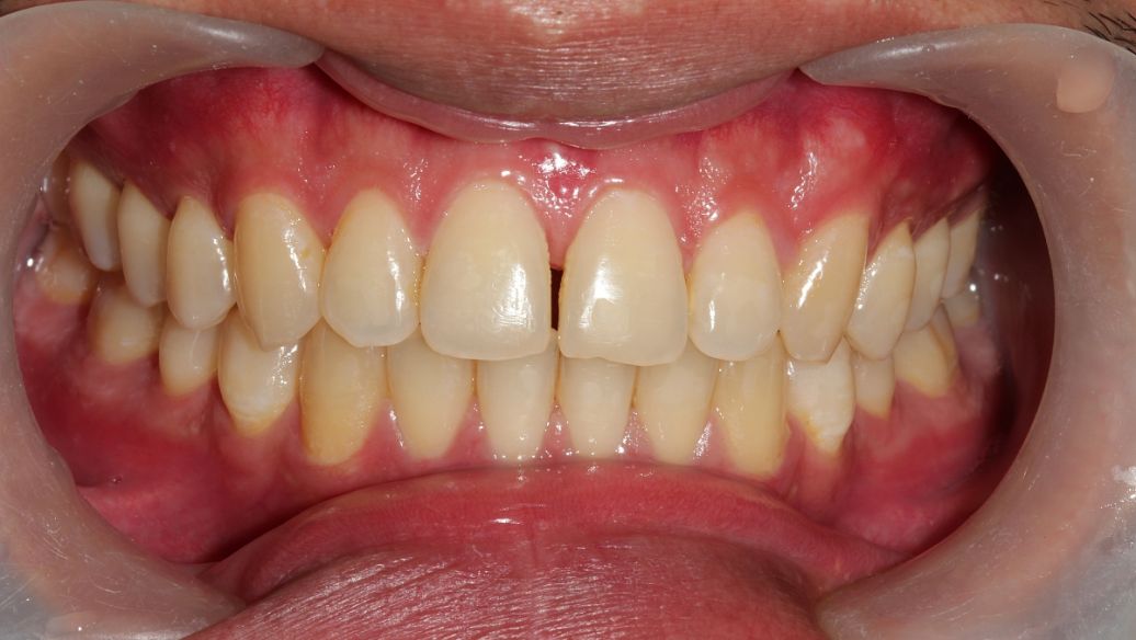 Loperamide Hydrochloride uses | Shaanxi BLOOM Tech Co., Ltd Loperamide Hydrochloride uses | Shaanxi BLOOM Tech Co., Ltd